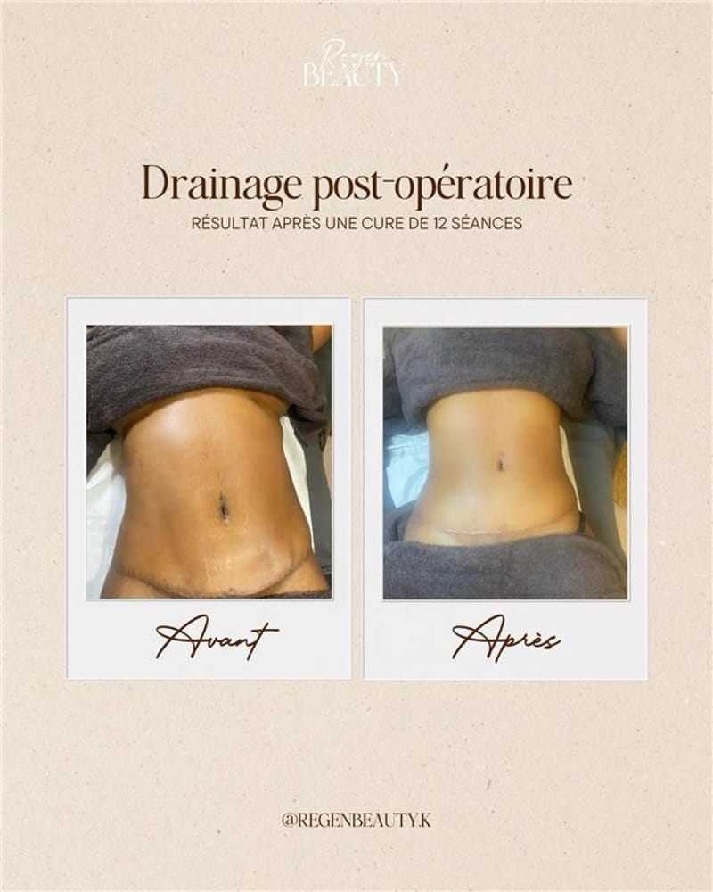 Post 10 by Regen Beauty - Madérothérapie, Drainage Lympathique & PostOp IDF on Instagram (image)