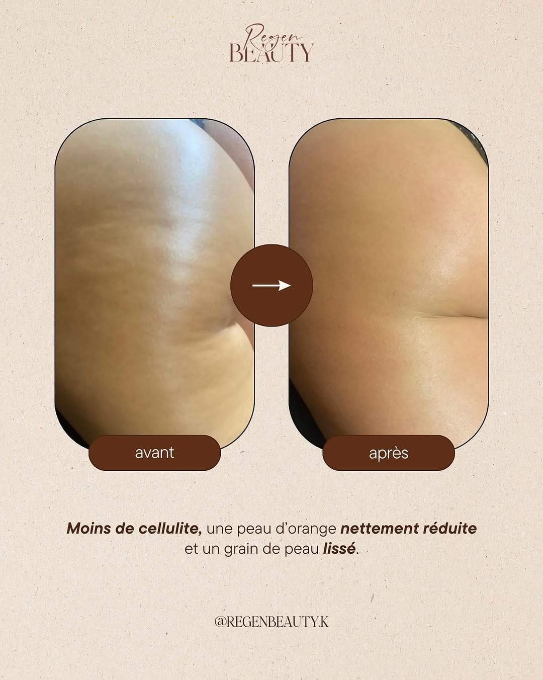 Post 3 by Regen Beauty - Madérothérapie, Drainage Lympathique & PostOp IDF on Instagram (image)