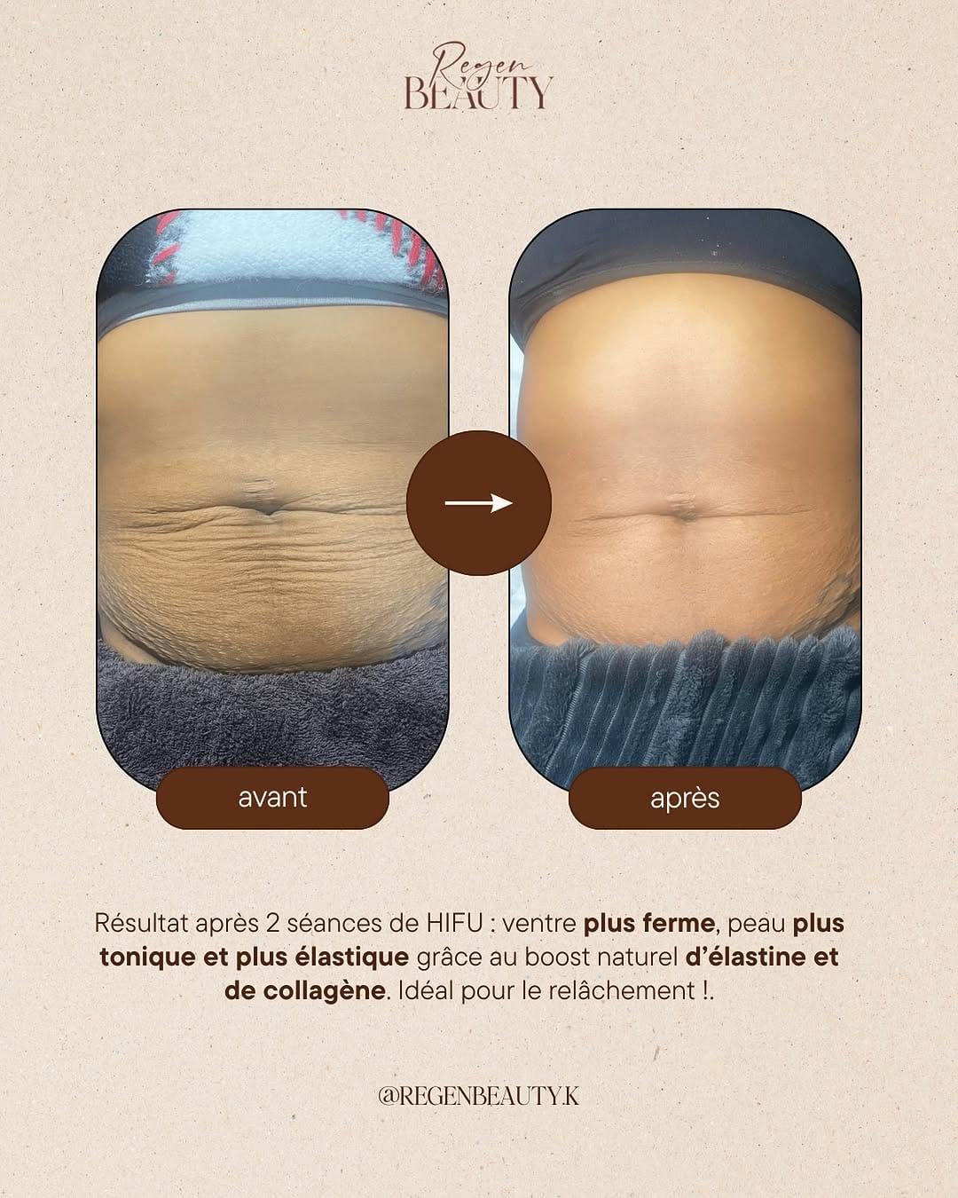 Post 5 by Regen Beauty - Madérothérapie, Drainage Lympathique & PostOp IDF on Instagram (image)