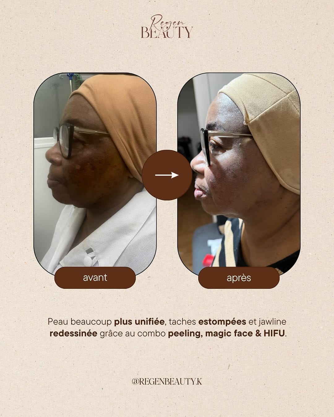 Post 4 by Regen Beauty - Madérothérapie, Drainage Lympathique & PostOp IDF on Instagram (image)