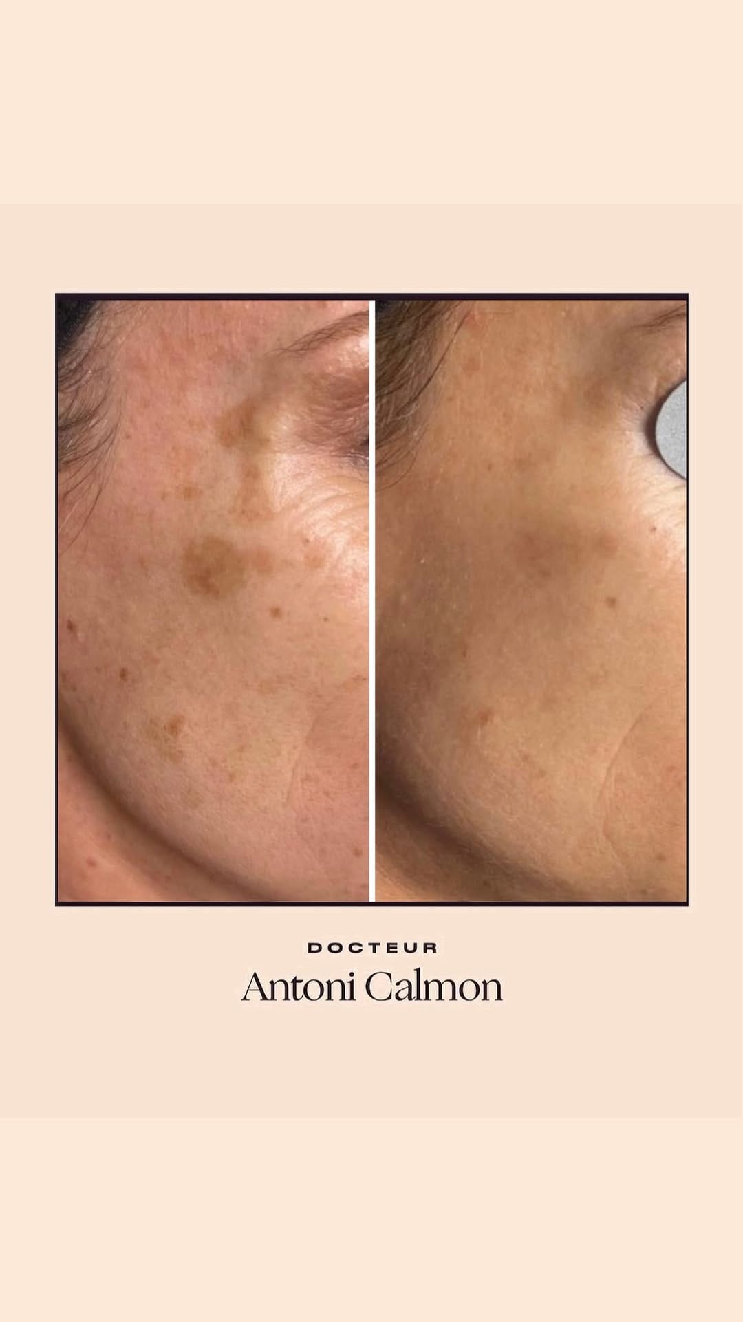 Post 2 by Dr Antoni Calmon on Instagram (video)