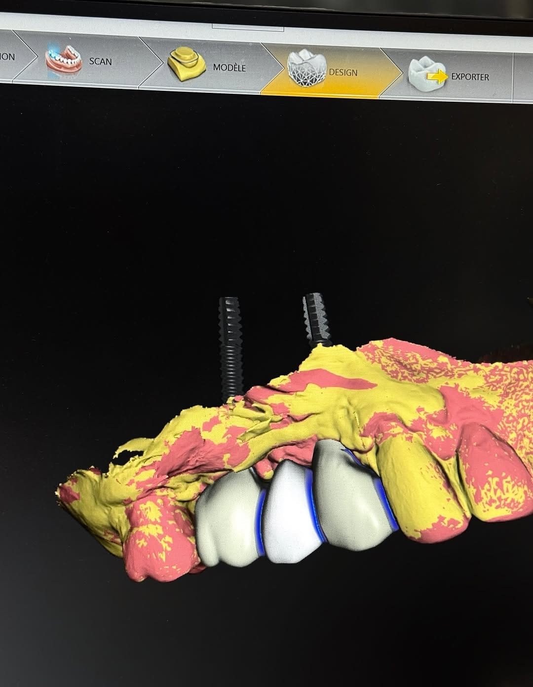 Post 10 by Dentiste paris /aesthetic dentistry / dr Cyrille fonteneau on Instagram (image)
