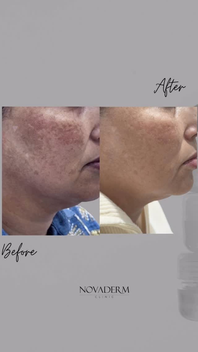 Post 6 by NOVADERM on Instagram (video)