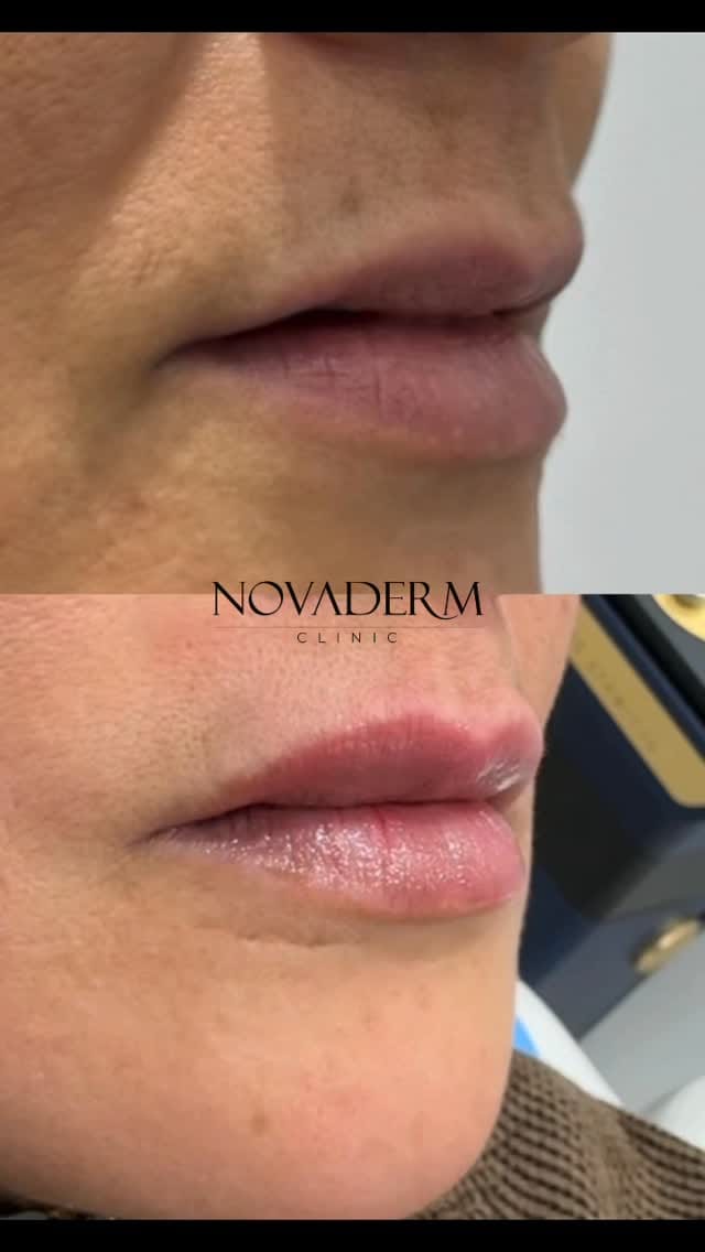 Post 9 by NOVADERM on Instagram (video)