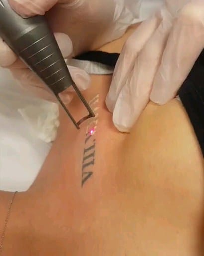 Post 5 by viva laser aluguel de maquinas depilaçao e despigmentação on Instagram (video)