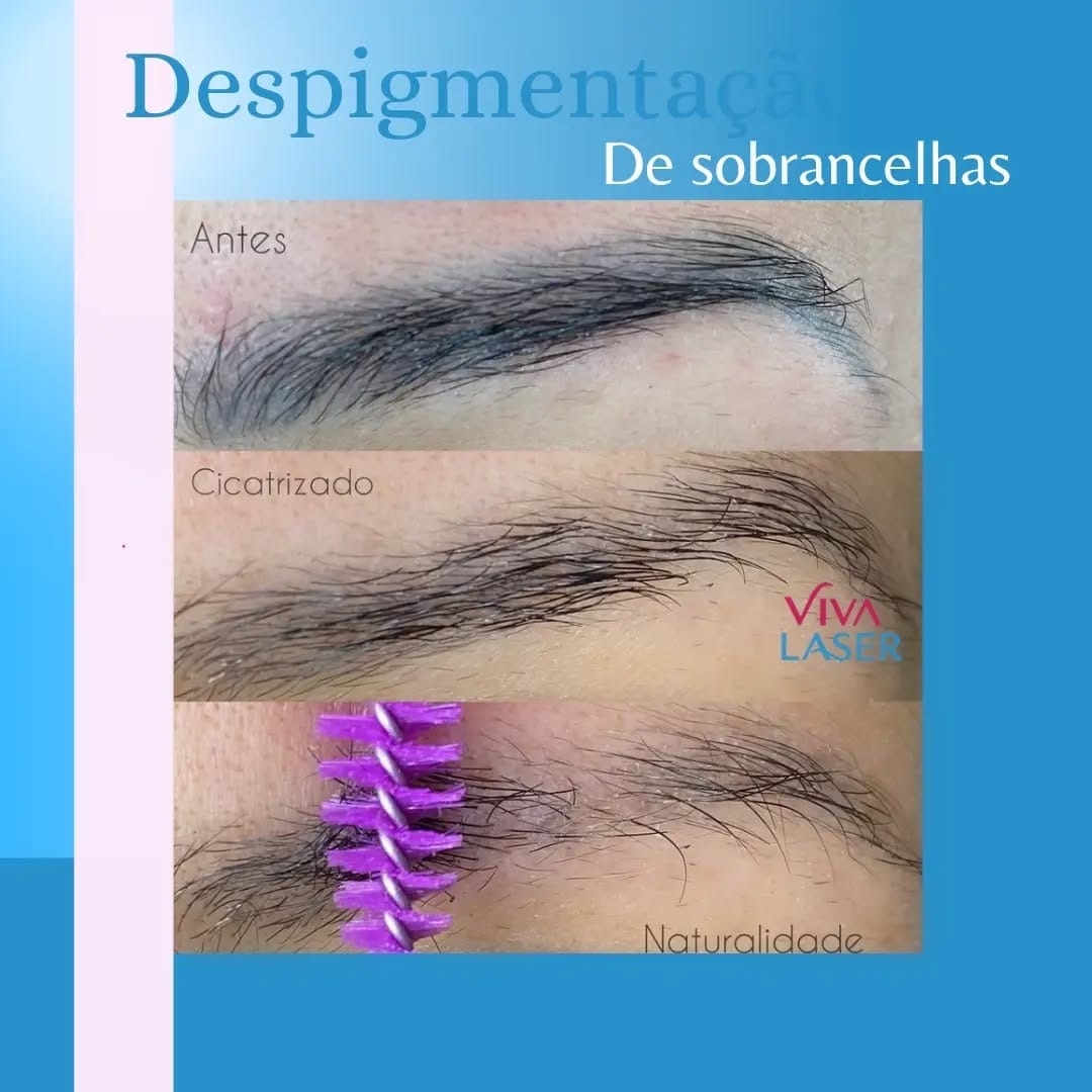 Post 6 by viva laser aluguel de maquinas depilaçao e despigmentação on Instagram (image)