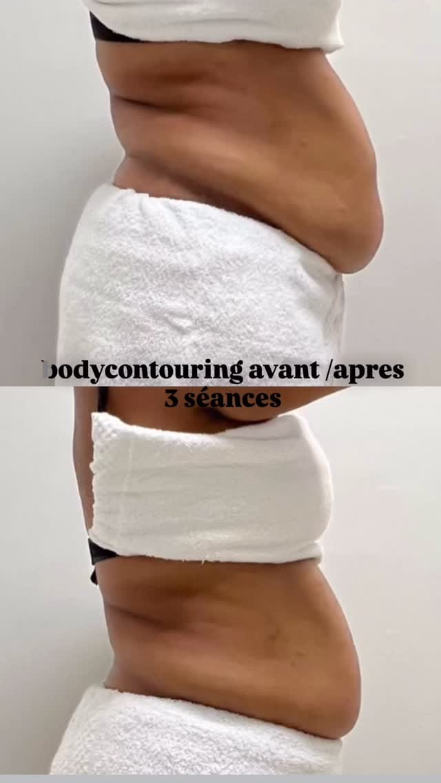 Post 2 by Bodycontouring /skincare/ aesthetic on Instagram (video)