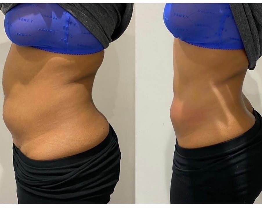 Post 5 by Bodycontouring /skincare/ aesthetic on Instagram (carousel)