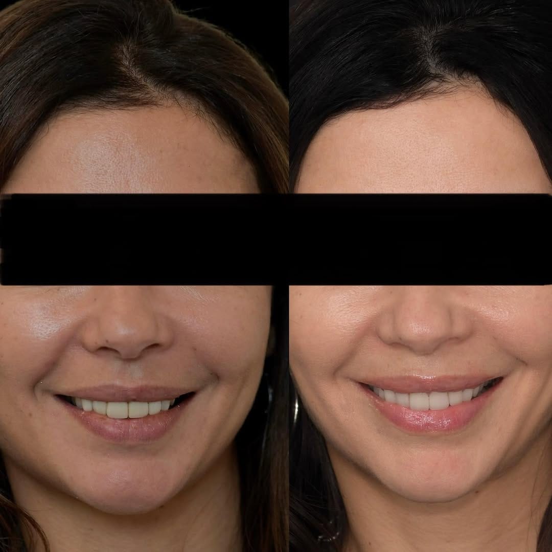 Post 1 by ELONE CLINIC-Dr. Ari Elhyani on Instagram (carousel)