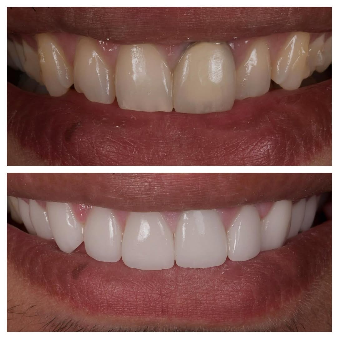 Post 6 by ELONE CLINIC-Dr. Ari Elhyani on Instagram (carousel)