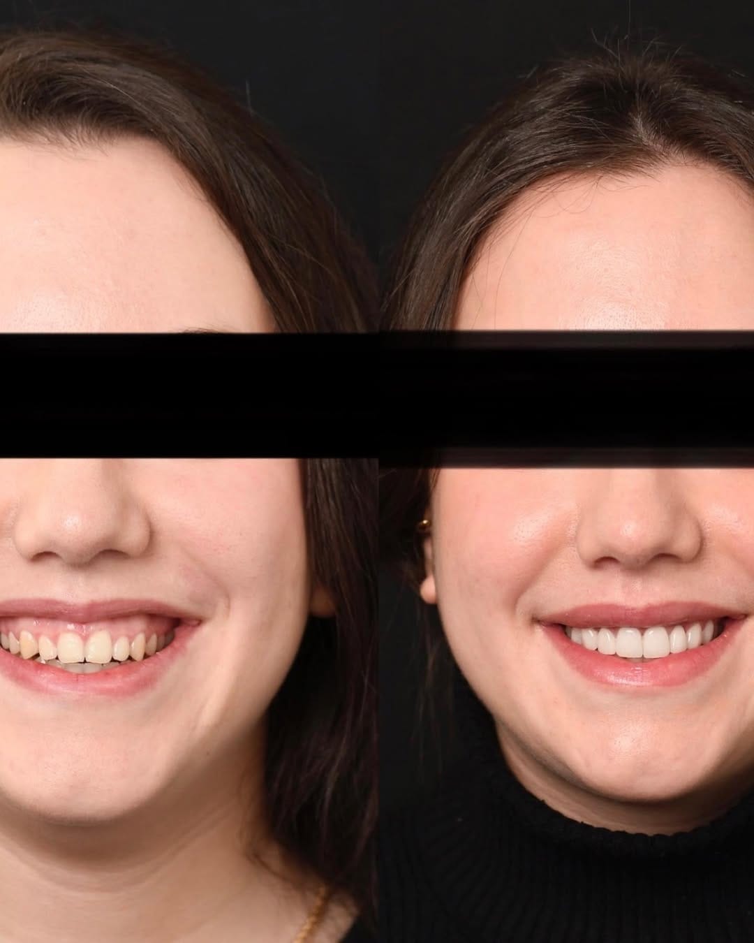 Post 3 by ELONE CLINIC-Dr. Ari Elhyani on Instagram (carousel)