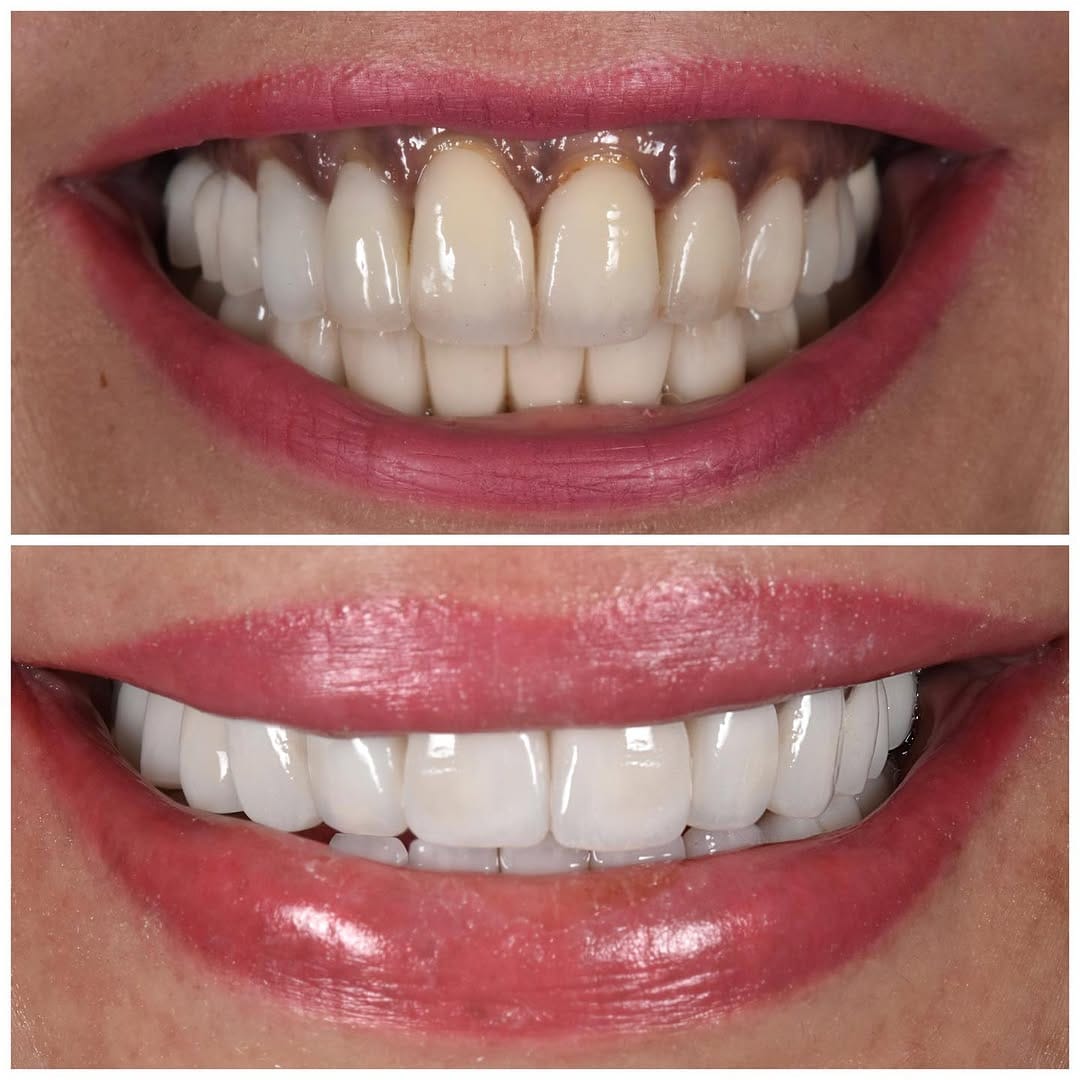 Post 4 by ELONE CLINIC-Dr. Ari Elhyani on Instagram (carousel)
