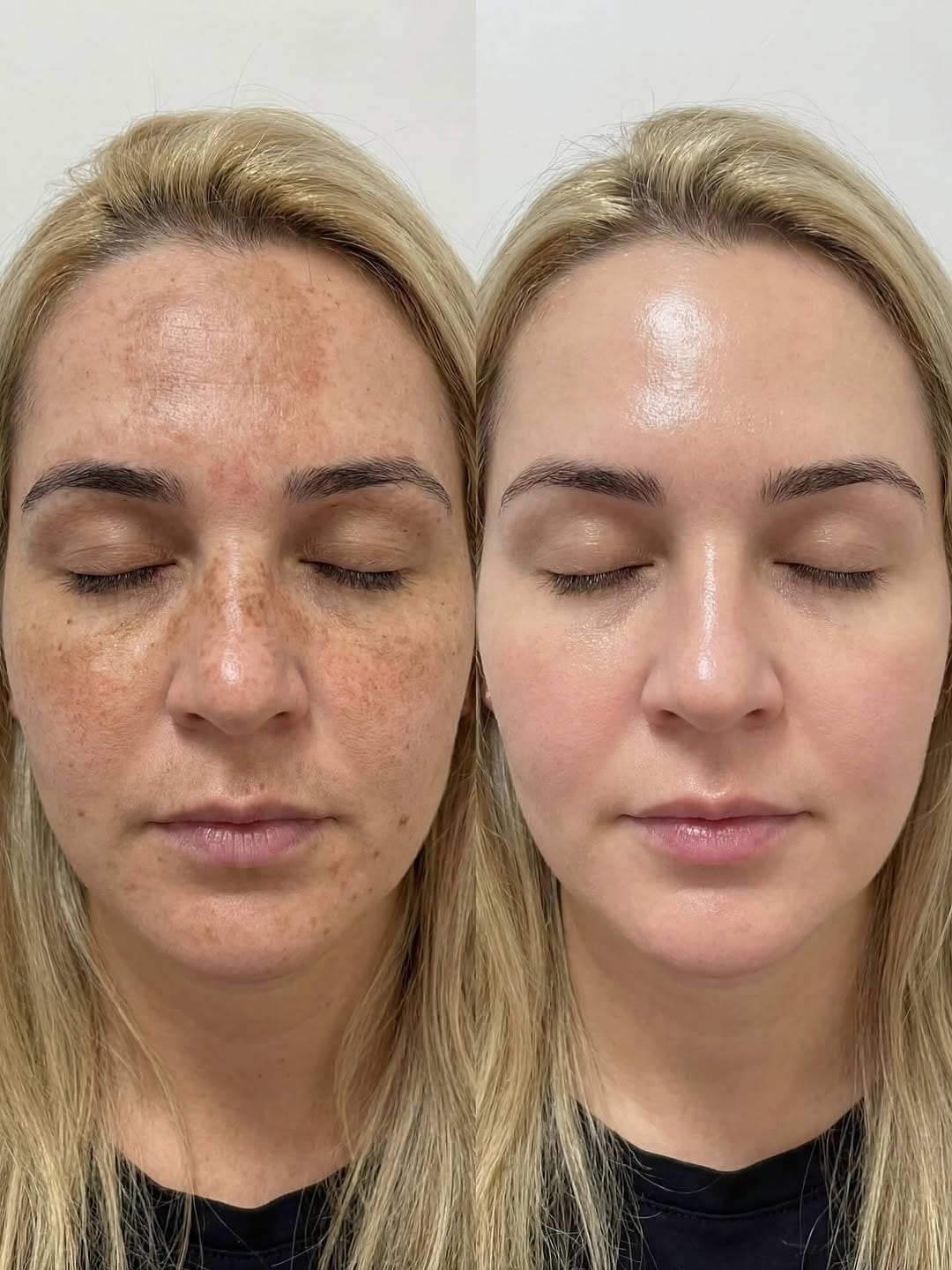Post 1 by My Laser Center on Instagram (image)