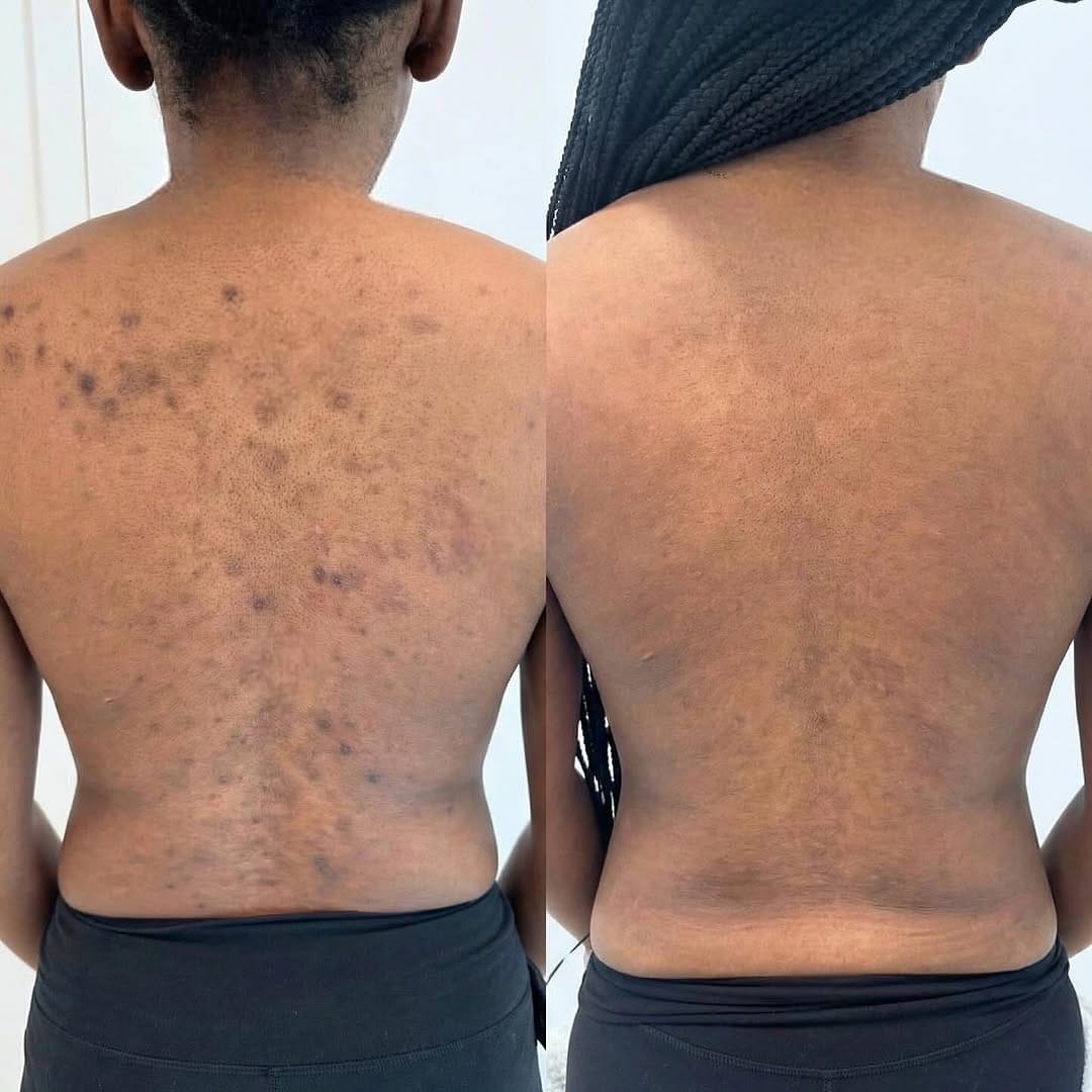 Post 10 by My Laser Center on Instagram (image)