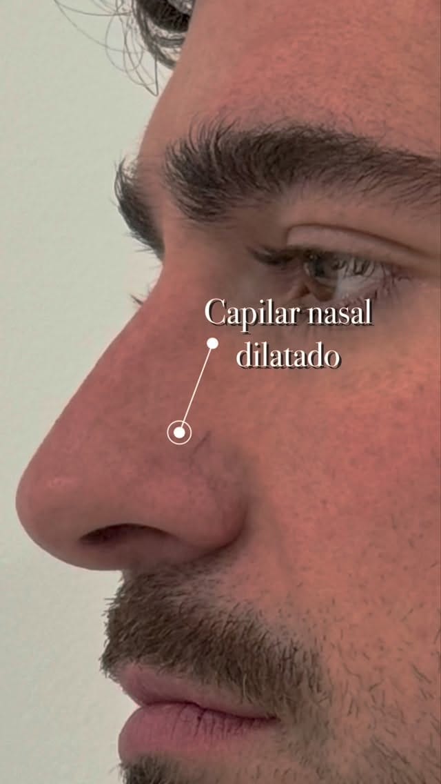 Post 8 by IDERMIC - Dermatología médica y estética on Instagram (video)
