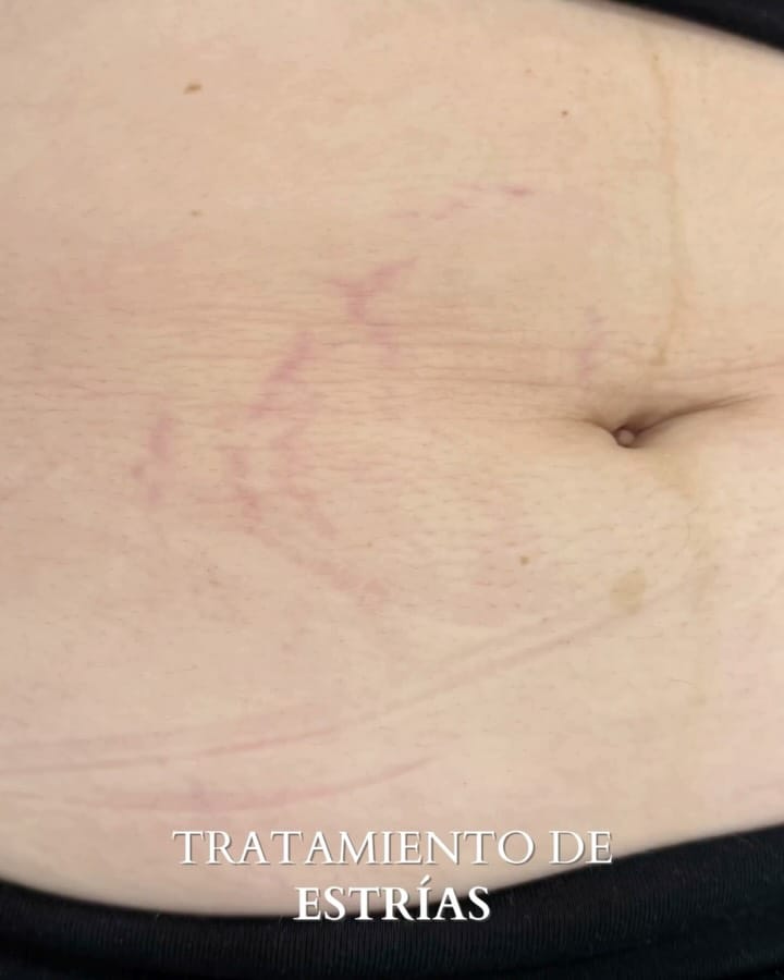Post 6 by IDERMIC - Dermatología médica y estética on Instagram (carousel)