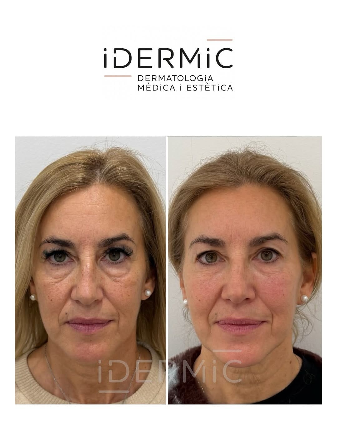 Post 5 by IDERMIC - Dermatología médica y estética on Instagram (carousel)