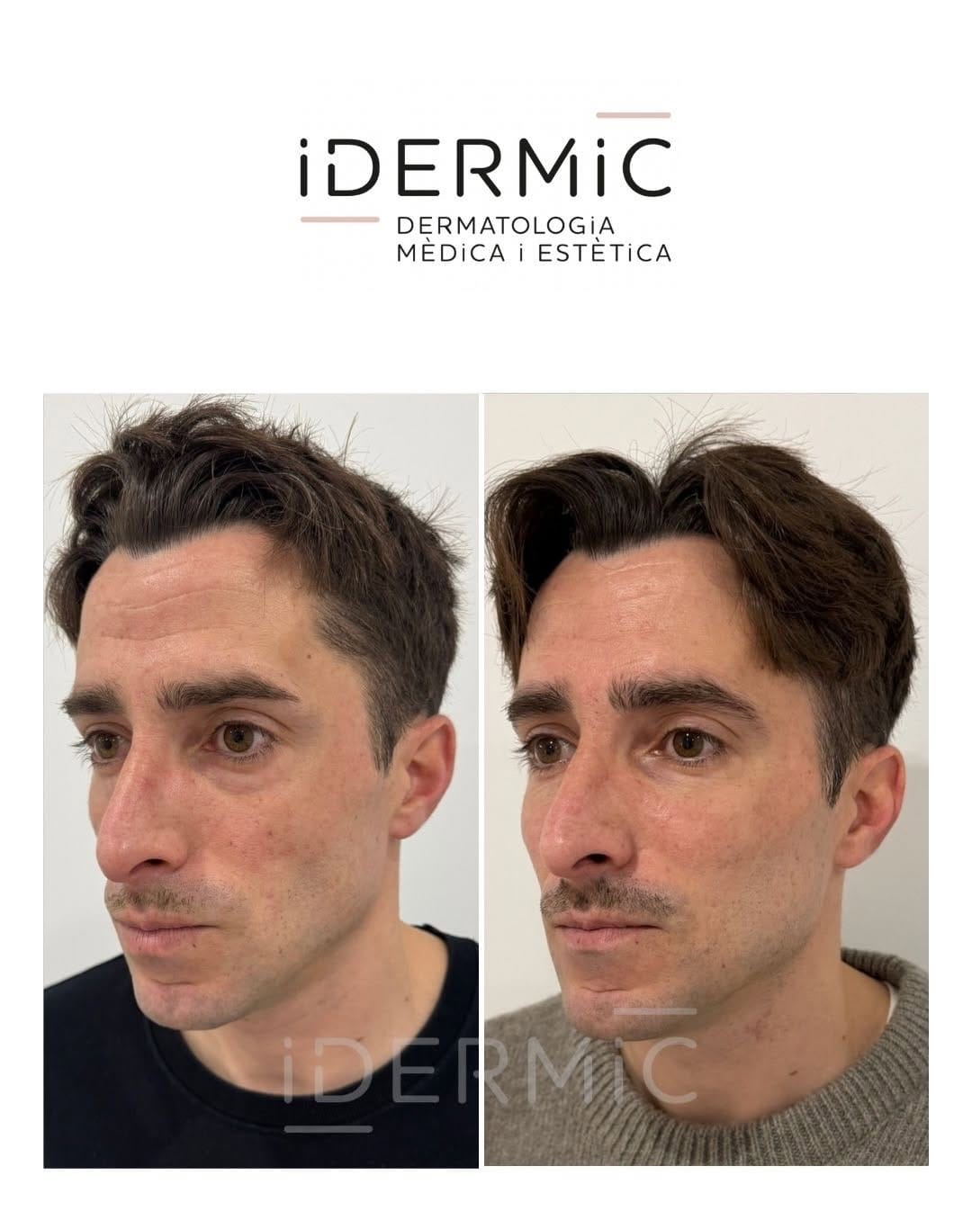 Post 9 by IDERMIC - Dermatología médica y estética on Instagram (carousel)