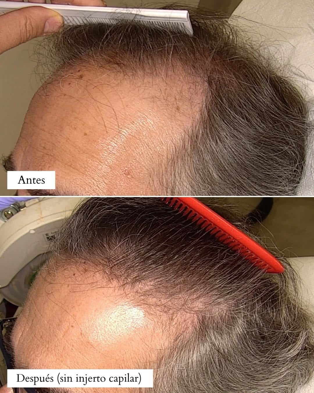 Post 10 by IDERMIC - Dermatología médica y estética on Instagram (carousel)