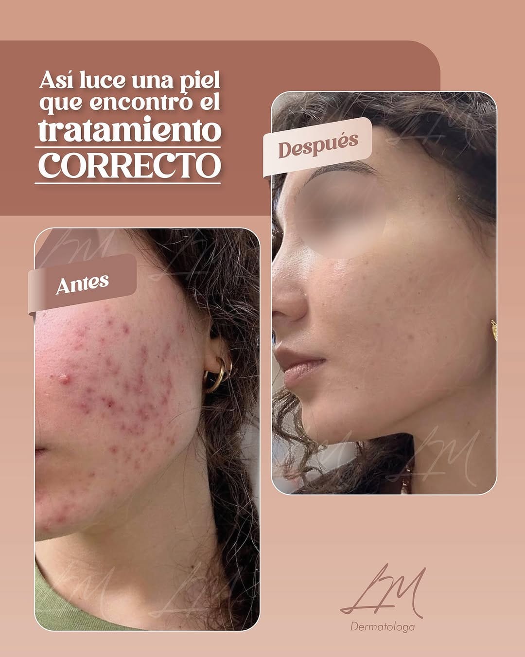 Post 8 by Dermatología | Labios | Botox | Bioestimulador | Peeling on Instagram (carousel)