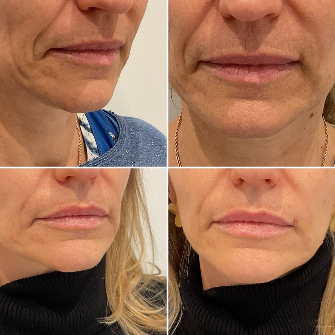 Post 1 by Dra. Victoria Caballero · Medicina Estética on Instagram (carousel)