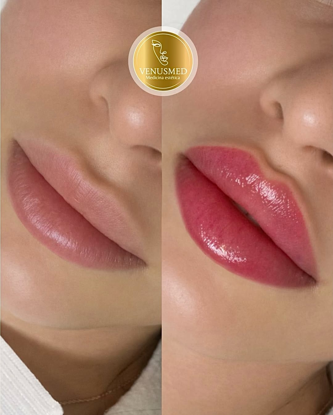 Post 8 by RUSSIAN LIPS▫️FULLFACE▫️ LIFTING SIN CIRUGÍA 📍MADRID | BARCELONA on Instagram (image)