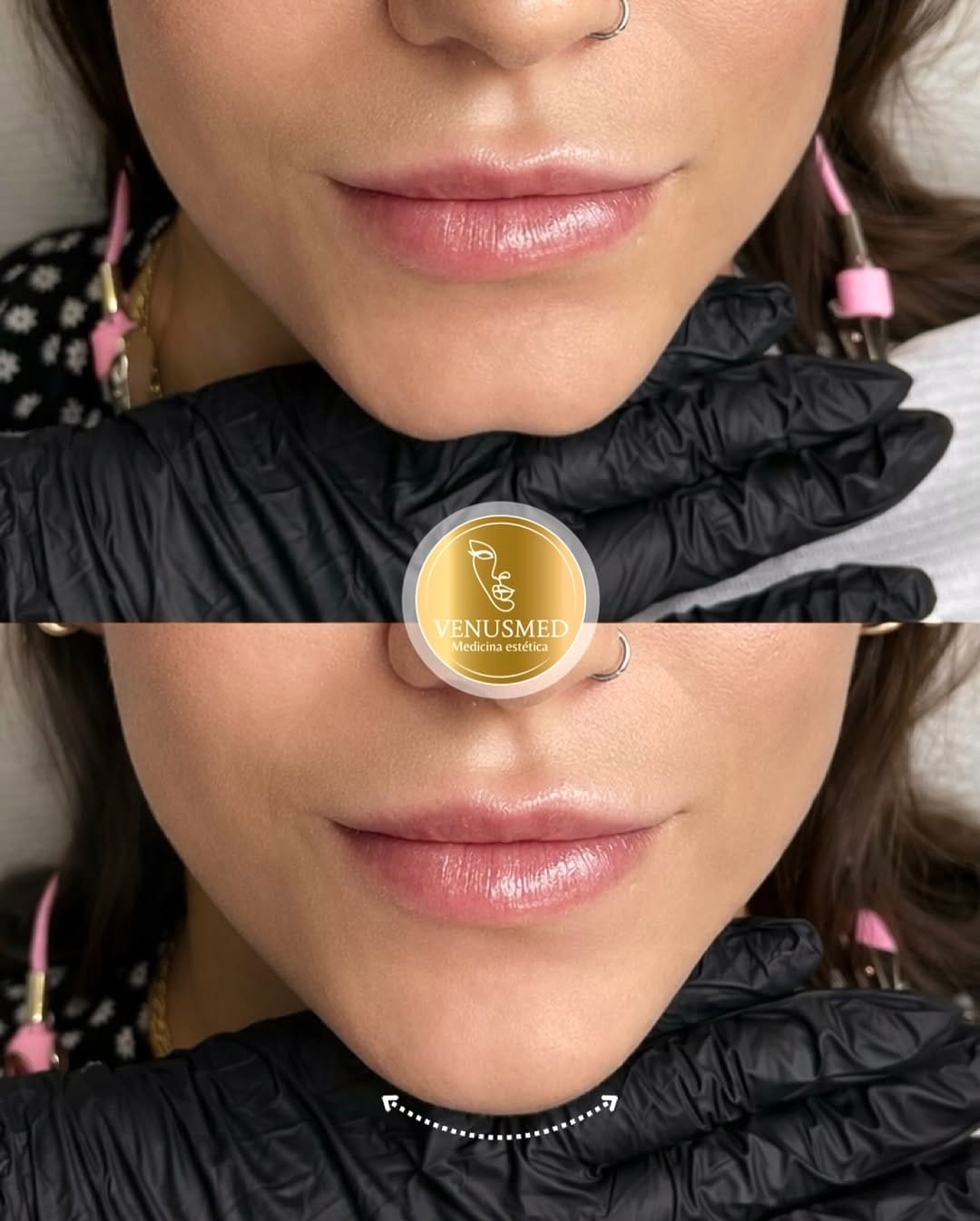 Post 2 by RUSSIAN LIPS▫️FULLFACE▫️ LIFTING SIN CIRUGÍA 📍MADRID | BARCELONA on Instagram (image)