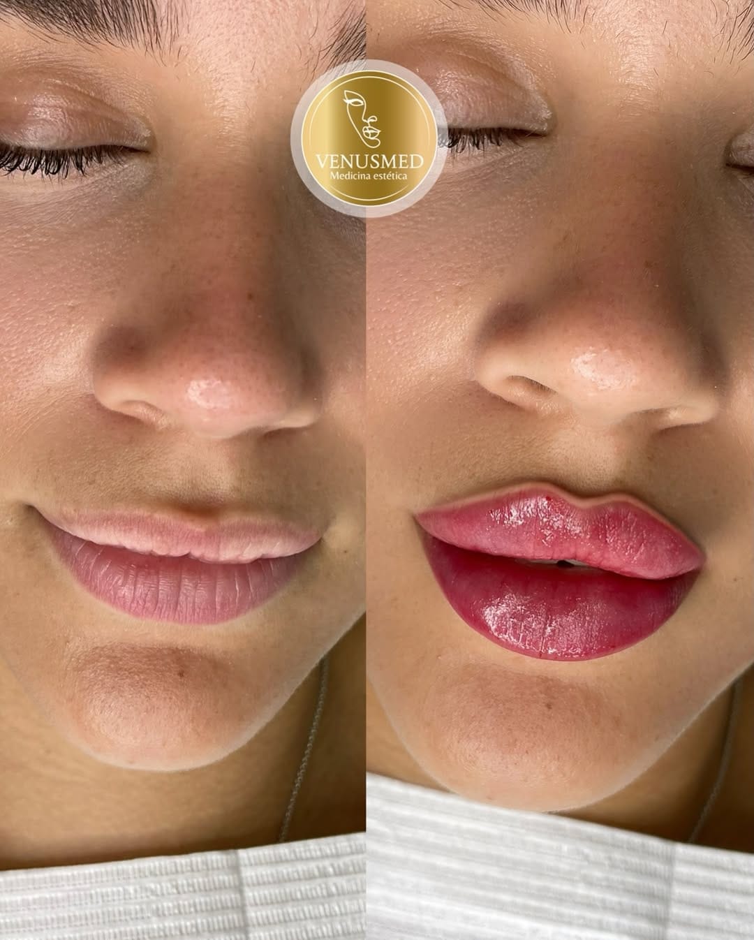 Post 3 by RUSSIAN LIPS▫️FULLFACE▫️ LIFTING SIN CIRUGÍA 📍MADRID | BARCELONA on Instagram (image)