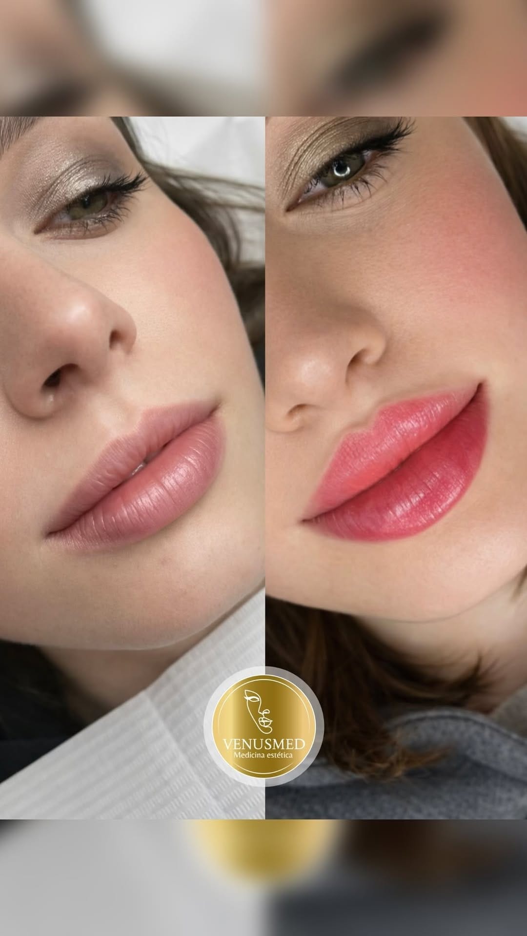 Post 5 by RUSSIAN LIPS▫️FULLFACE▫️ LIFTING SIN CIRUGÍA 📍MADRID | BARCELONA on Instagram (video)