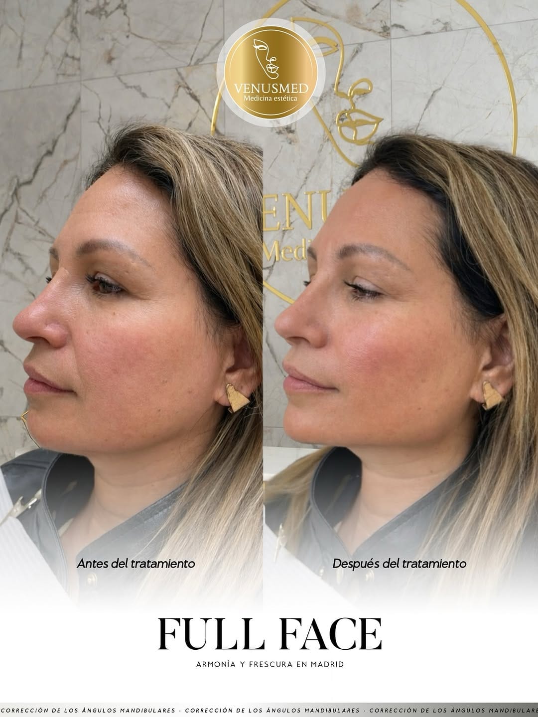Post 4 by RUSSIAN LIPS▫️FULLFACE▫️ LIFTING SIN CIRUGÍA 📍MADRID | BARCELONA on Instagram (image)