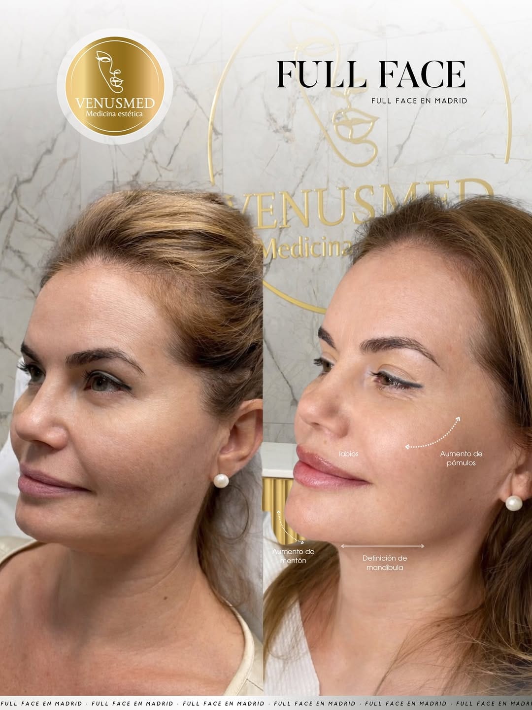 Post 6 by RUSSIAN LIPS▫️FULLFACE▫️ LIFTING SIN CIRUGÍA 📍MADRID | BARCELONA on Instagram (image)