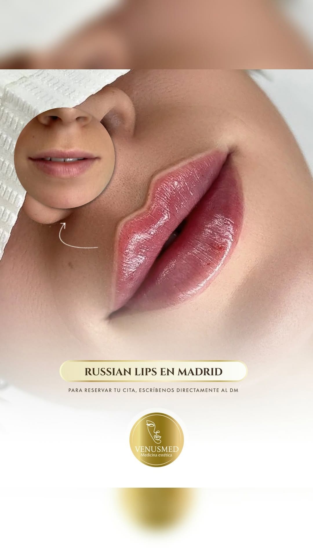 Post 10 by RUSSIAN LIPS▫️FULLFACE▫️ LIFTING SIN CIRUGÍA 📍MADRID | BARCELONA on Instagram (video)