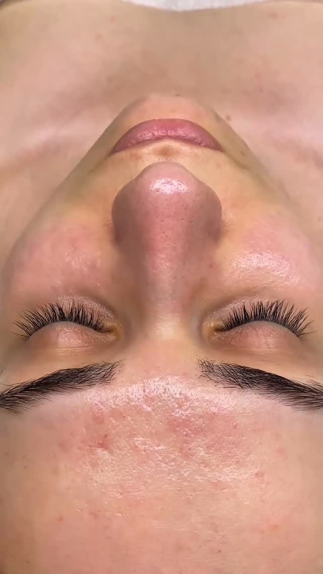 Post 4 by ERAESTHETIC | Clínica Medicina y Estética Avanzada on Instagram (video)