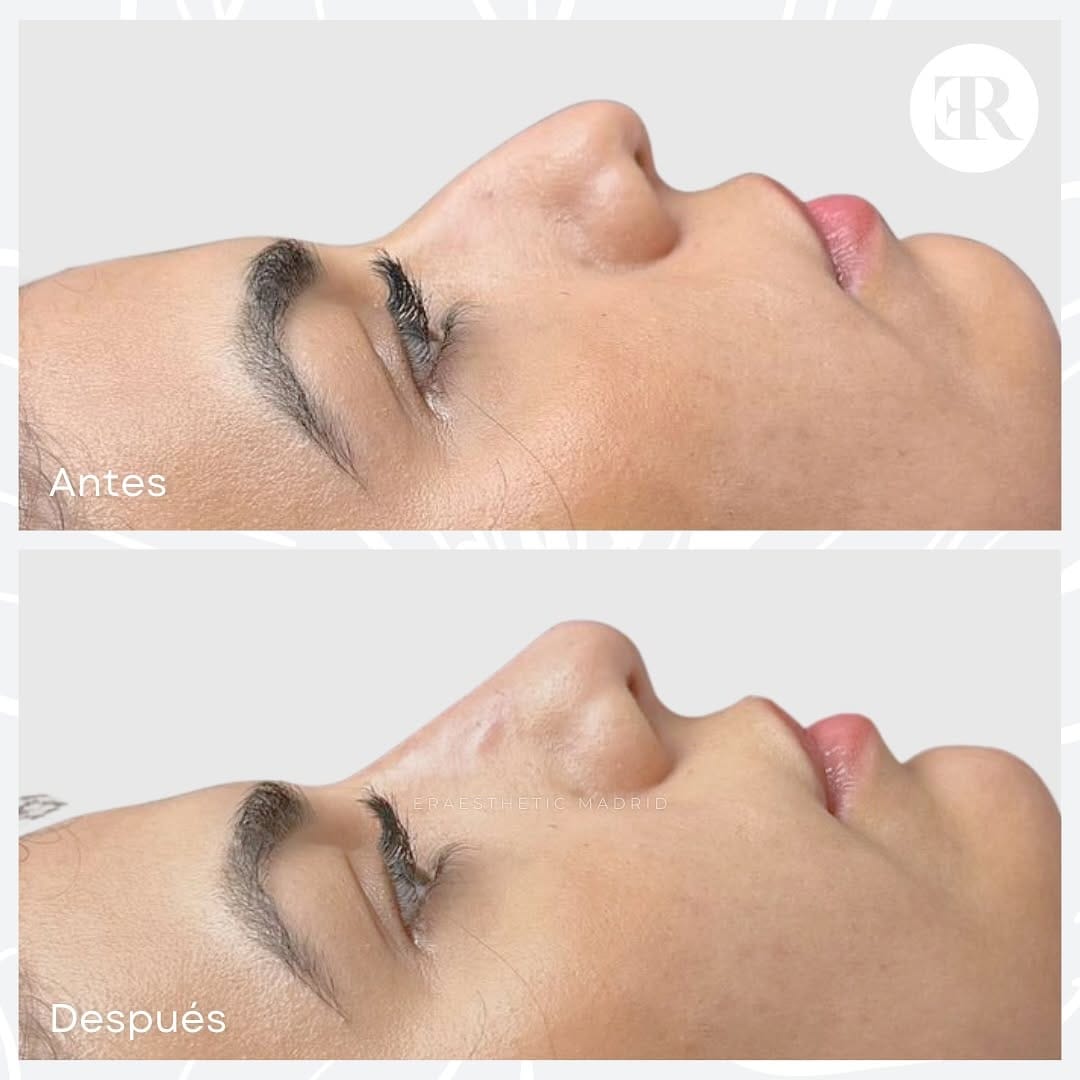 Post 8 by ERAESTHETIC | Clínica Medicina y Estética Avanzada on Instagram (carousel)