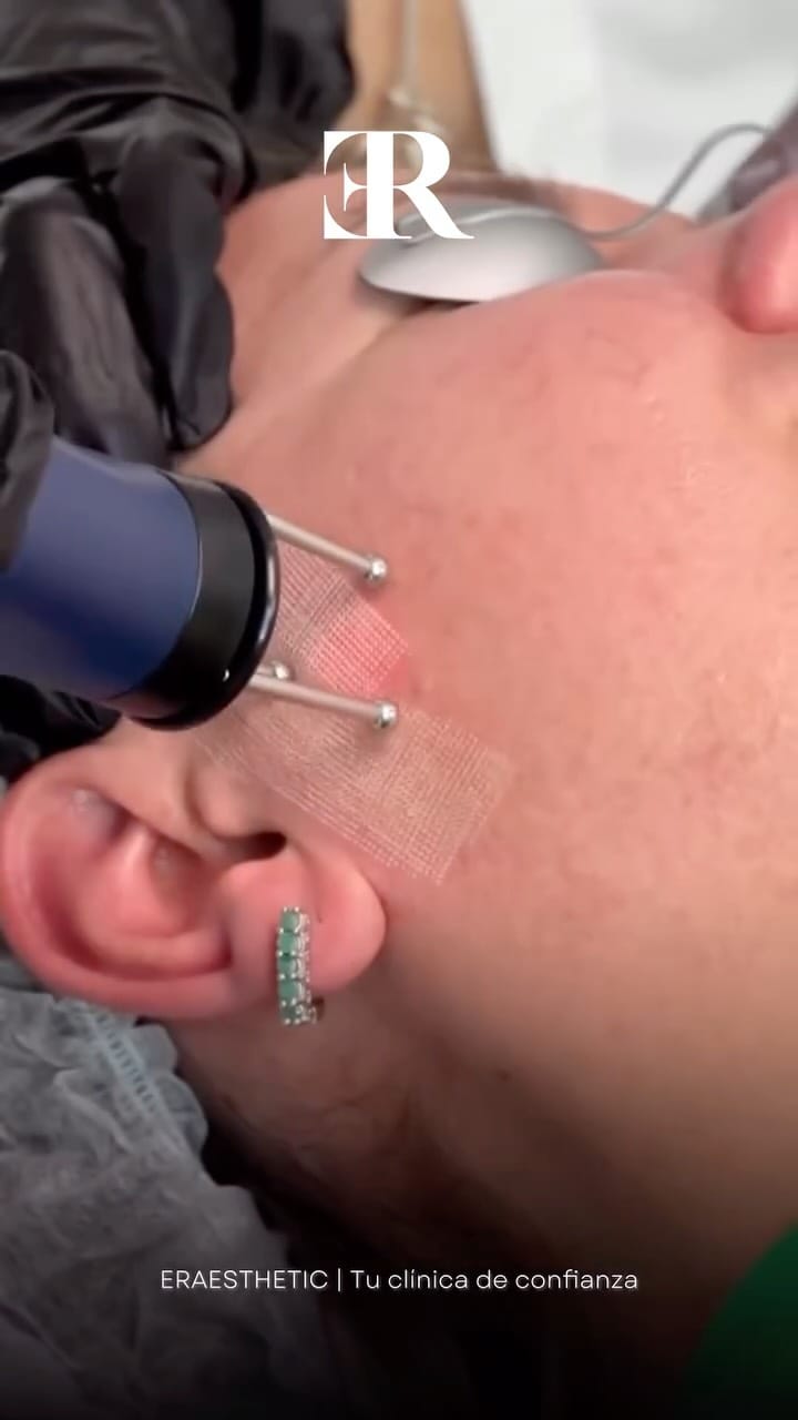 Post 9 by ERAESTHETIC | Clínica Medicina y Estética Avanzada on Instagram (video)