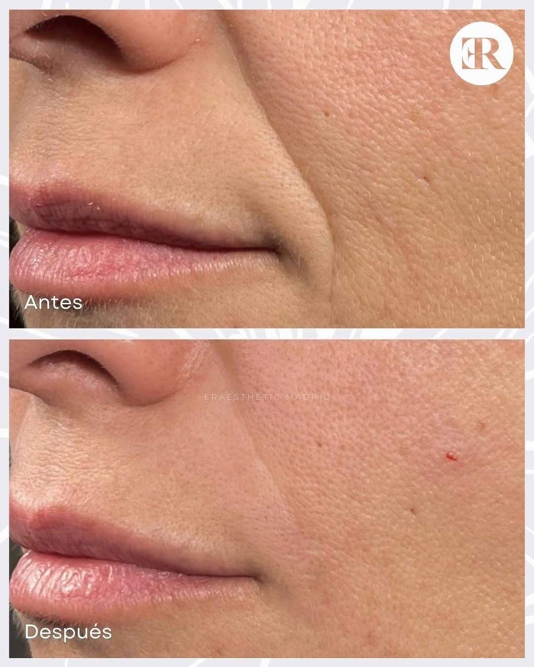 Post 2 by ERAESTHETIC | Clínica Medicina y Estética Avanzada on Instagram (carousel)