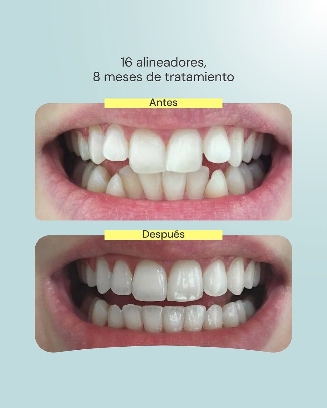 Post 9 by GlamAline | Expertos en alineadores invisibles on Instagram (image)