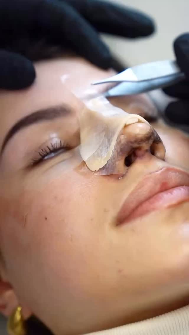 Post 5 by Dr. BLAS GARCIA | Rinoplastia on Instagram (video)
