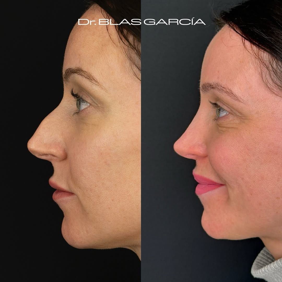 Post 4 by Dr. BLAS GARCIA | Rinoplastia on Instagram (carousel)