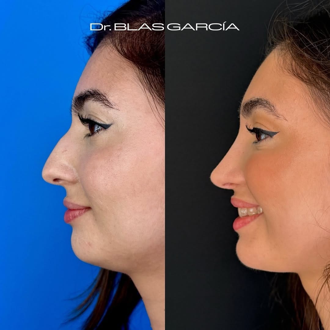 Post 3 by Dr. BLAS GARCIA | Rinoplastia on Instagram (carousel)