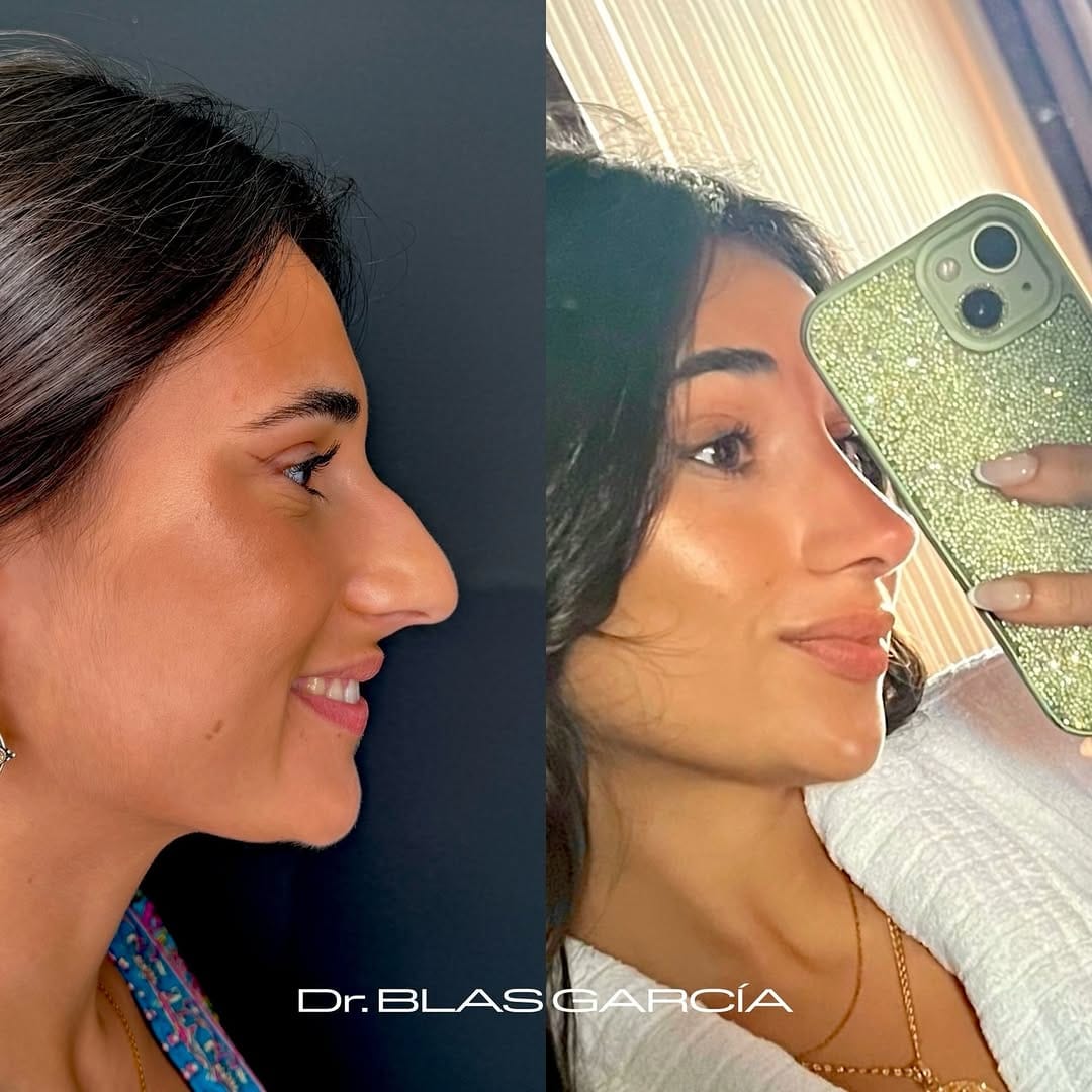 Post 9 by Dr. BLAS GARCIA | Rinoplastia on Instagram (carousel)