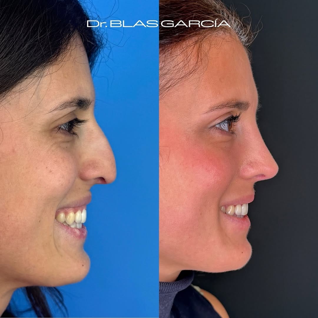 Post 8 by Dr. BLAS GARCIA | Rinoplastia on Instagram (carousel)
