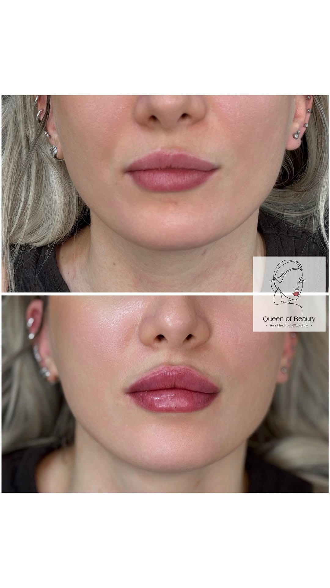 Post 6 by Advanced aesthetic clinics London/Marbella on Instagram (video)