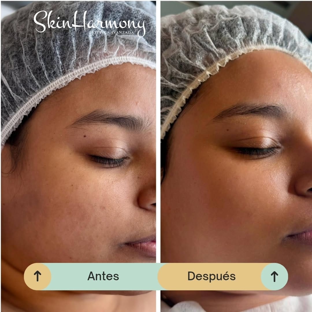 Post 6 by Skin Harmony Estetica Avanzada on Instagram (carousel)