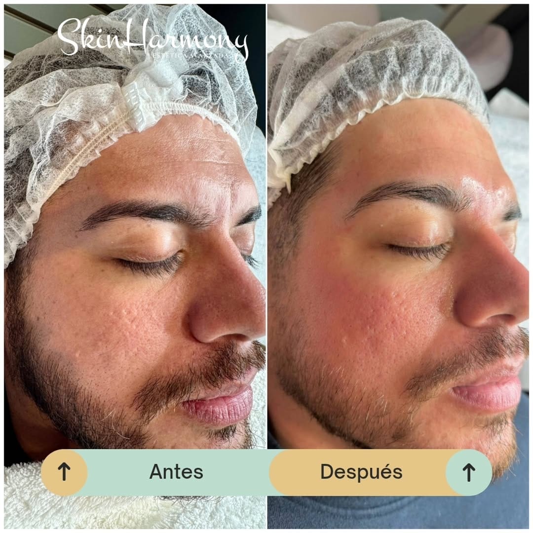 Post 1 by Skin Harmony Estetica Avanzada on Instagram (carousel)