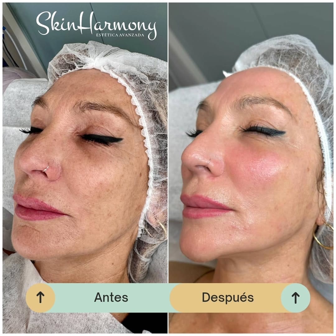 Post 3 by Skin Harmony Estetica Avanzada on Instagram (carousel)