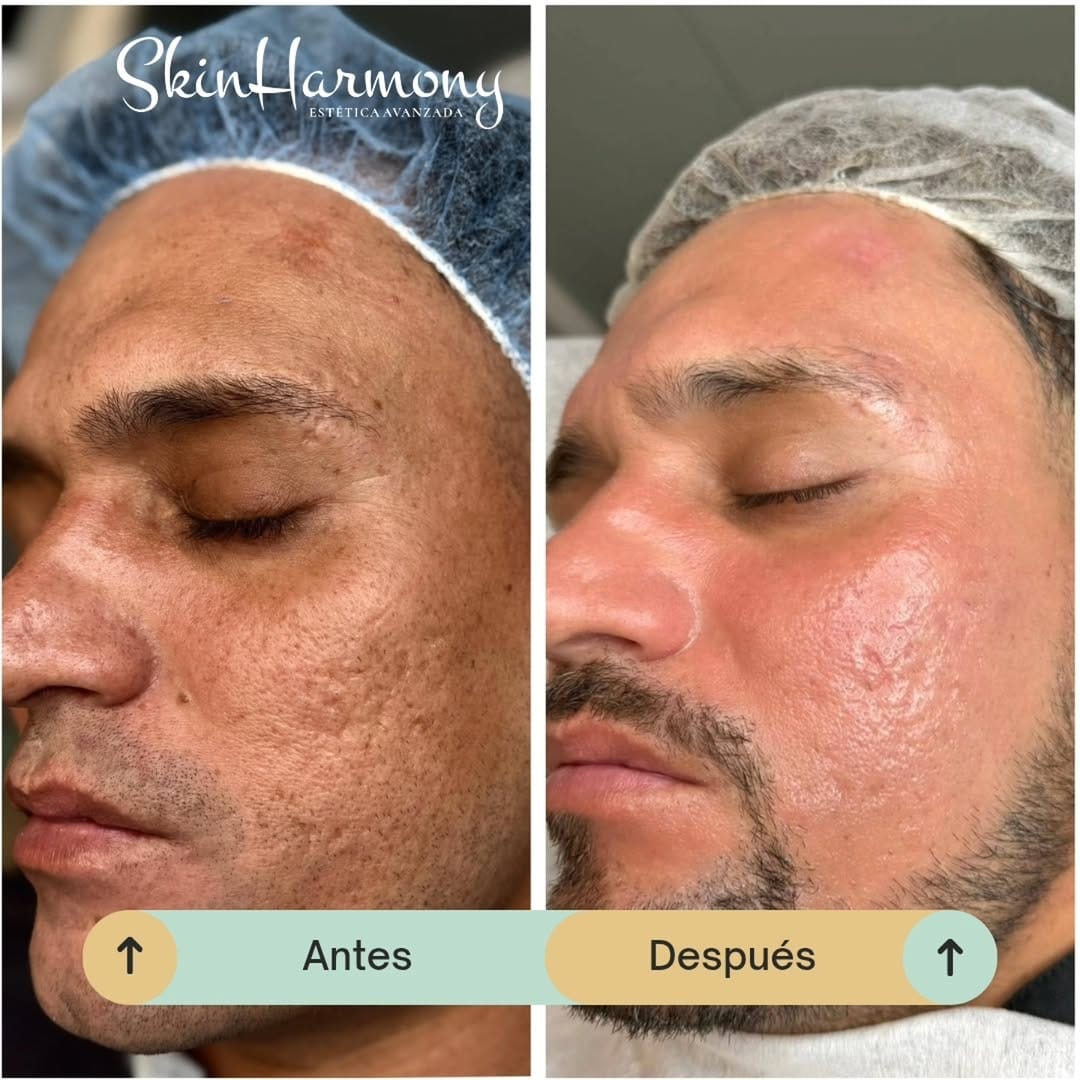 Post 5 by Skin Harmony Estetica Avanzada on Instagram (carousel)