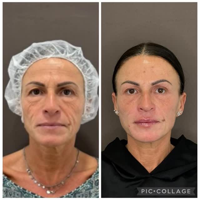Post 5 by Dra. Martan. Medicina Estética on Instagram (video)