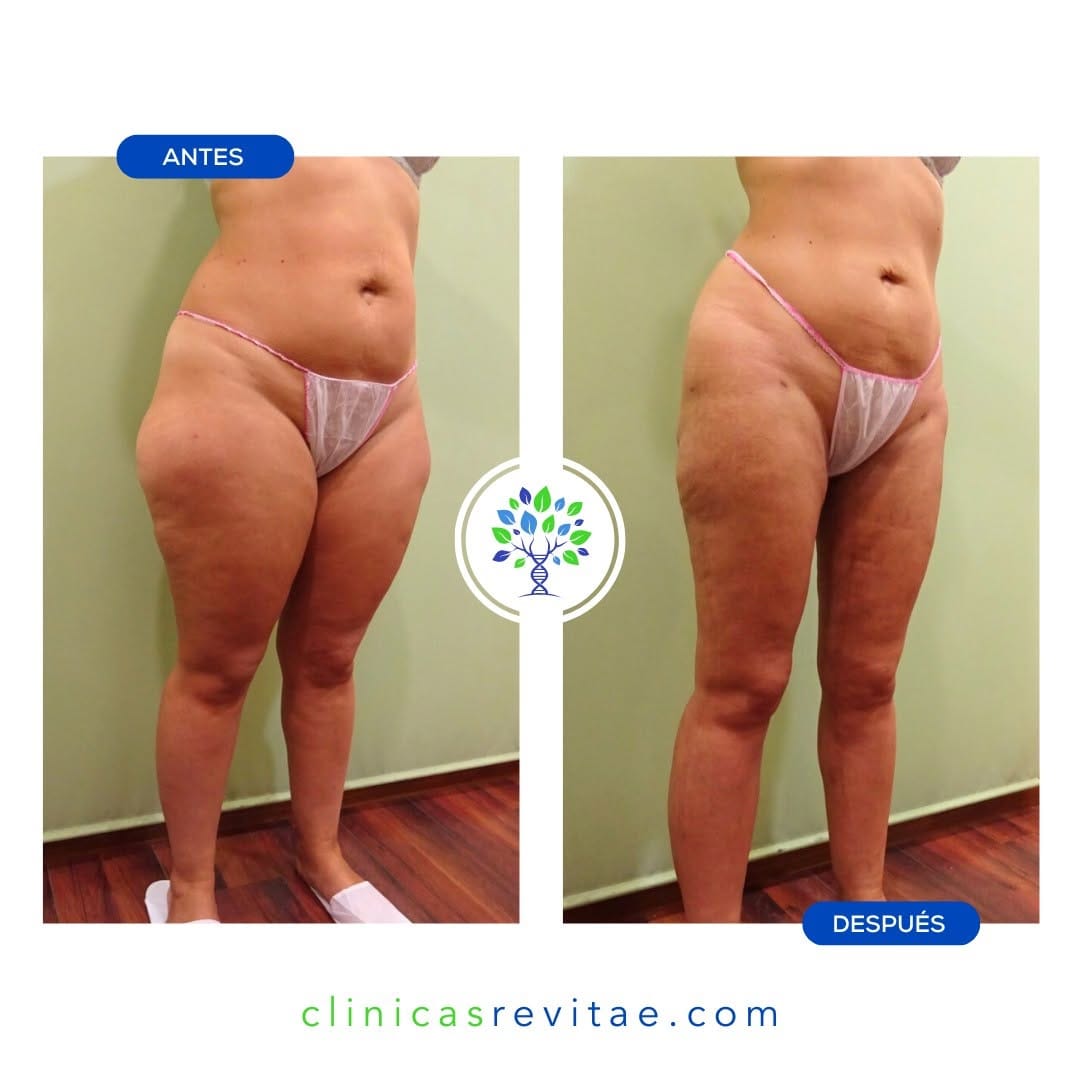 Post 1 by Clínicas Revitae del Doctor Oyola on Instagram (carousel)