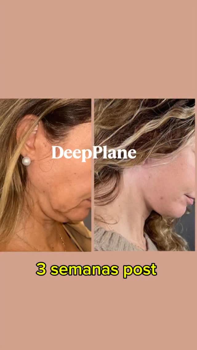 Post 6 by Doctor Mauricio Verbauvede on Instagram (video)